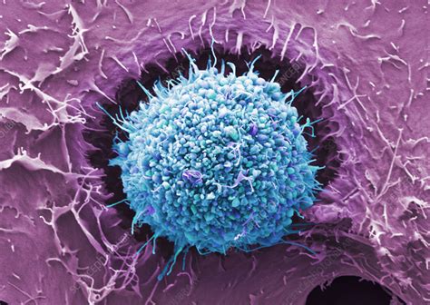 Cervical Cancer Cell Sem Stock Image C Science Photo Library