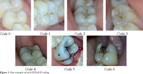 Figure 1 From Icdas II Criteria International Caries Detection And