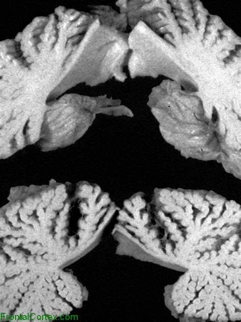 Sagittal Sections Through Autopsy Cerebellum Gm2 Gangliosidosis Tay