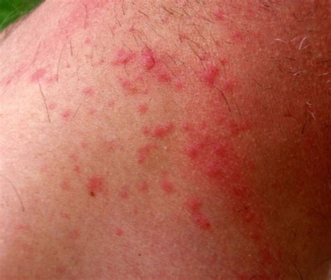 Brown Tail Moth Rash Pictures | Medical Pictures and Images - (2023 ...