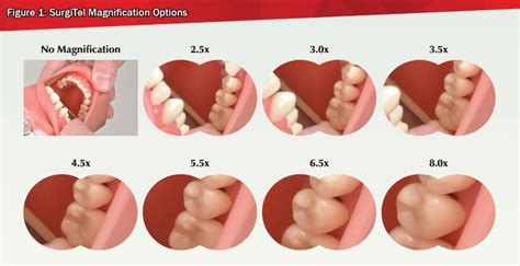 What Is The Right Loupe Magnification For Me Surgitel
