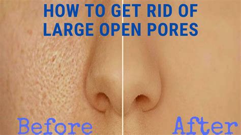 How To Get Rid Of Large Open Pores खुले रोम छिद्र Home Remedy Youtube