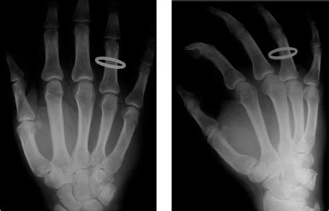 Figure 2 From Ulnar Sesamoids Fracture Of The Thumb An Unusual Injury
