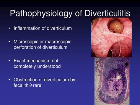 Ppt Diverticular Disease Powerpoint Presentation Free Download Id4744596