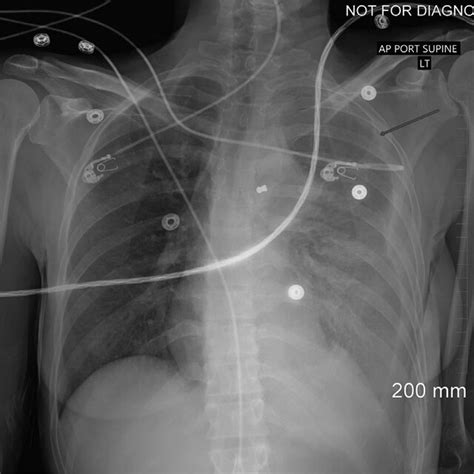 Portable Chest X Ray On Arrival Large Hemopneumothorax Demonstrated