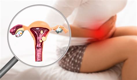 Endometriosis Gejala Penyebab Dan Pengobatannya