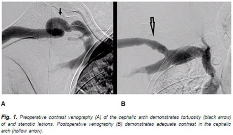 Brachial Cephalic Fistula