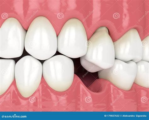 D Render Of Jaw With Protruding Tooth Revealing Root Stock Photography