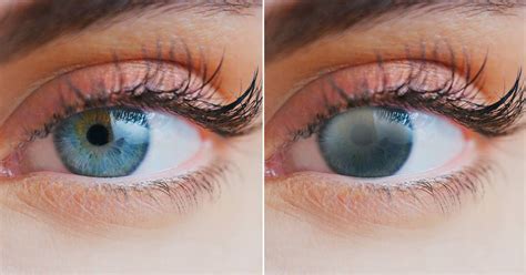 Superdrug Health Clinic: Que Son Las Cataratas En Los Ojos