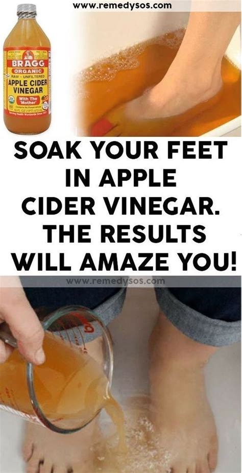 Quickcoldsoreremedies Apple Cider Vinegar Remedies Apple Cider Vinegar Foot Soak Foot Soak