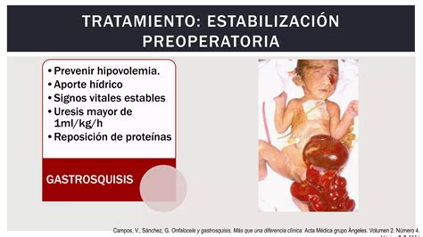 Gastrosquisis Y Onfalocele Ppt