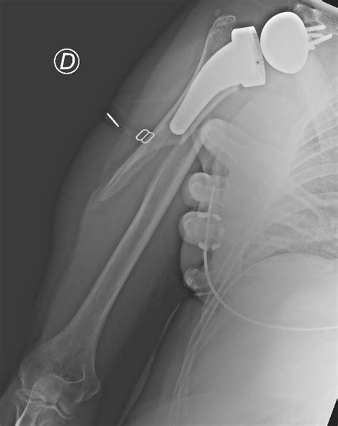 Periprosthetic Humeral Fractures After Reverse Shoulder Arthroplasty