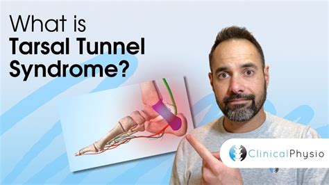 Tarsal Tunnel Syndrome Expert Physio Guide Youtube