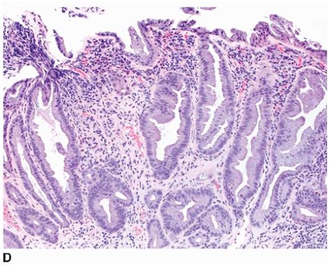 Showing 4 Serrated Polyp Subtypes A Microvesicular