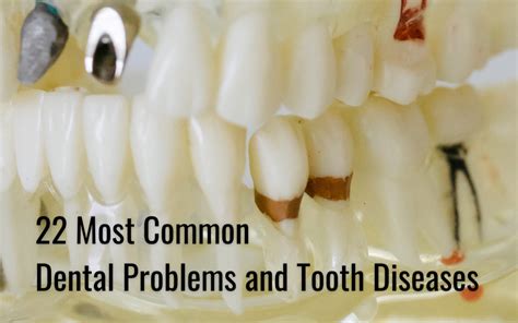 22 Most Common Dental Problems And Common Tooth Diseases