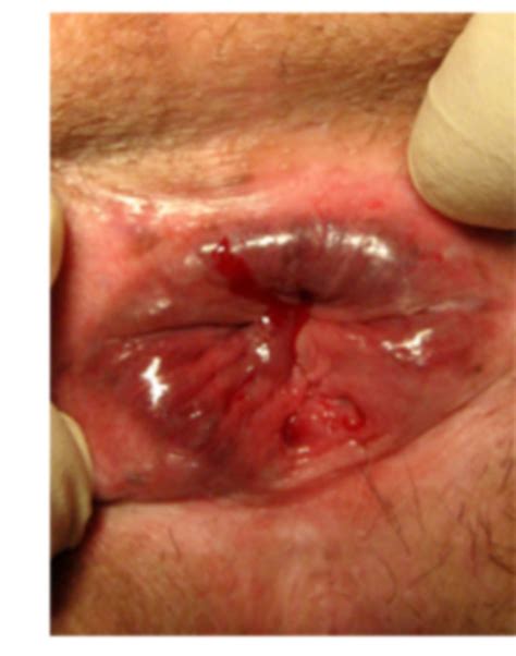 Treatment For Anal Fissures Philadelphia Holistic Clinic Dr Tsan