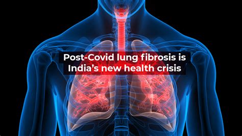 Post Covid Lung Fibrosis Is Indias New Health Crisis Times Of India