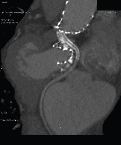 Six Month Follow Up Results After Tavr A Cardiac Computed Tomography