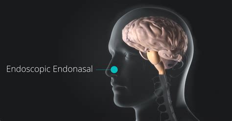 Endonasal Endoscopic Surgery Robert Louis Md