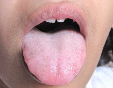 8 Great Home Remedies For Coated Tongue - Home Remedies For All Kinds ...