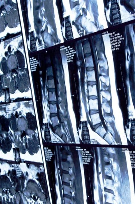 Spinal Cord Injury Lawyers Let Us Help You Weitz And Luxenberg