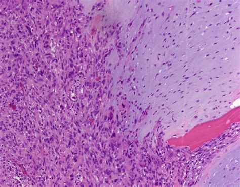 Histologic Variants Of Chondrosarcoma Diagnostic Histopathology