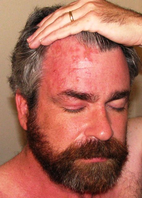 Shingles Vaccine Symptoms Treatment Contagious Pictures Causes Diseases Lab