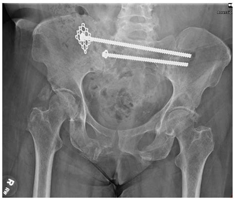 Fixation of Sacral Ala Fracture Using a Midfoot Mesh Plate as a