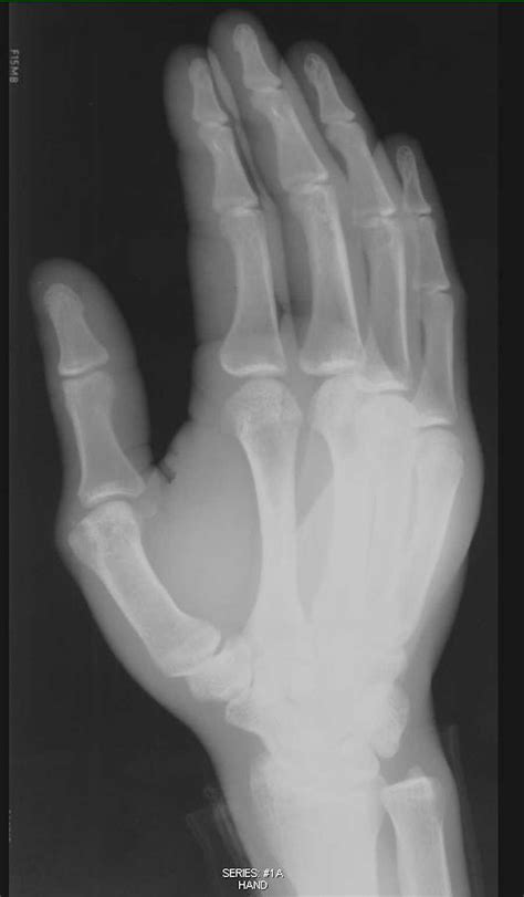 X Ray Hand With Soft Tissue Swelling X Rays Case Studies Ctisus Ct