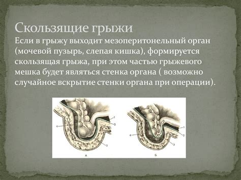 Операции на передней брюшной стенке. Грыжи и герниопластика - online ...