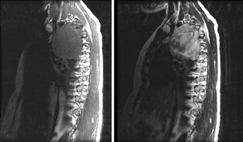 Figure From Giant Radiation Induced Thoracic Malignant Schwannoma