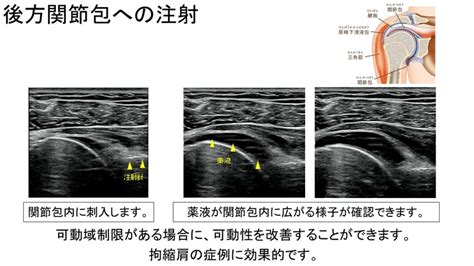 超音波ガイド下注射 上田整形外科内科