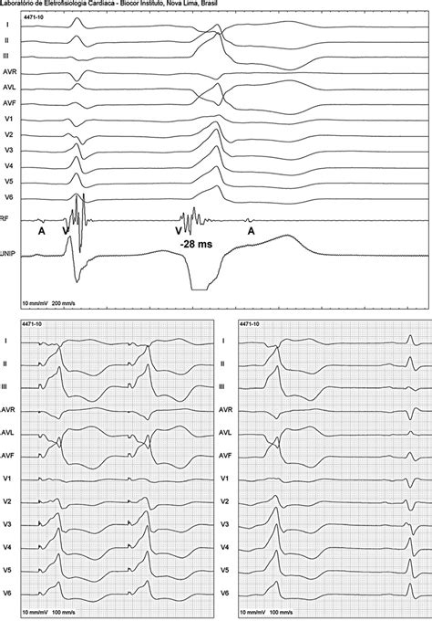 Top Activation Mapping Showing 28 Ms Of Local Ventricular Activation