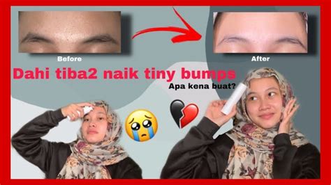 Cara Nak Menghilangkan Tiny Bumps Di Muka Zaidenafecuevas