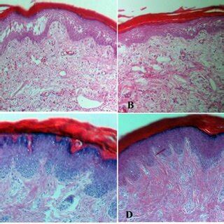 Photomicrographs Of Rat Inflamed Paw N A Carrageenan Control B