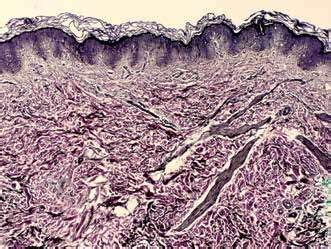 Staining of elastic fibers showing changes mainly in the middle and ...