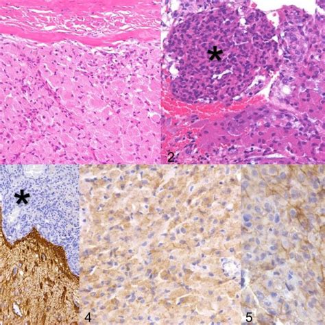 Case No 2 Foci Of Meningothelial Like Tumor Cells In Tumor Tissue