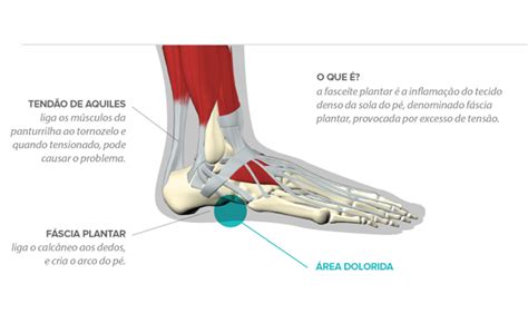 Fascite Plantar Fisiar