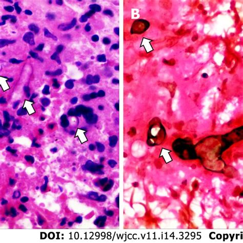 Postoperative Histopathological Results Of The Left Lower Lobe Mass A