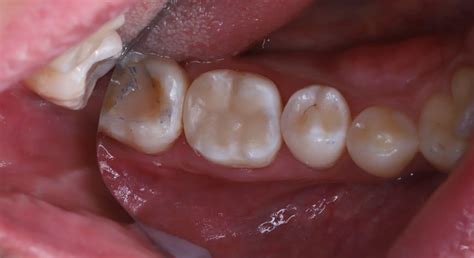 Endodontic Re Treatment Of Mandibular Molar With Endo Perio Lesion And Broken Instrument сases