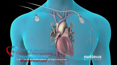 Cardioversion Dr Hetal R Bhakta Youtube