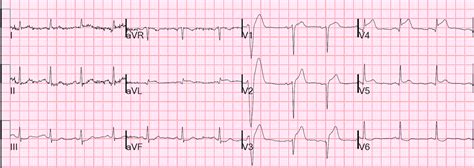 Dr Smith S Ecg Blog Subtle Lad Occlusion With Pseudonormalization Of