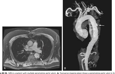 Figure From Acute Aortic Dissection Penetrating Aortic Ulcer