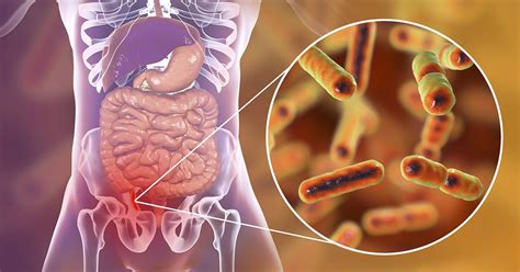 Apendicitis qué es síntomas y tratamiento