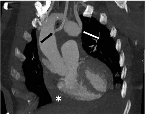 Figure 1 From Right Aortic Arch And Kommerell S Diverticulum Associated