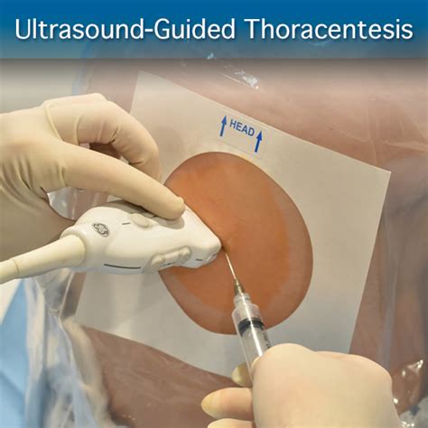 Ultrasound-Guided Thoracentesis: Procedure Module – SonoSim