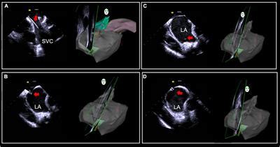 Frontiers Intracardiac Echocardiography Chinese Expert Consensus