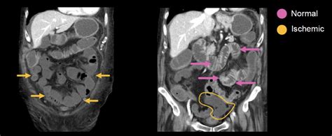 Abdominal Ct Phases • Litfl • Radiology Library