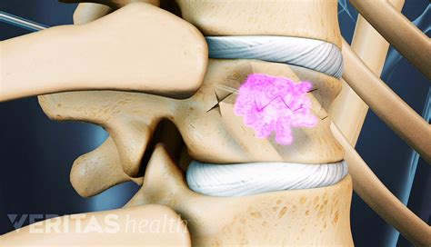 Compression Fracture Treatment | Spine-health