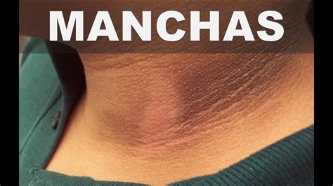 Con Esto Puedes Eliminar Las Manchas Oscuras En El Cuello O Acantosis